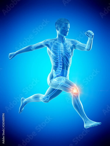 3d rendered medically accurate illustration of a runners painful kee