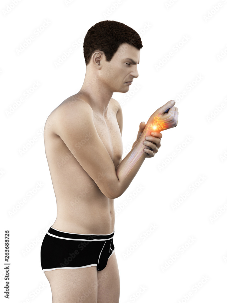 Fototapeta premium 3d rendered medically accurate illustration of a mans painful wrist