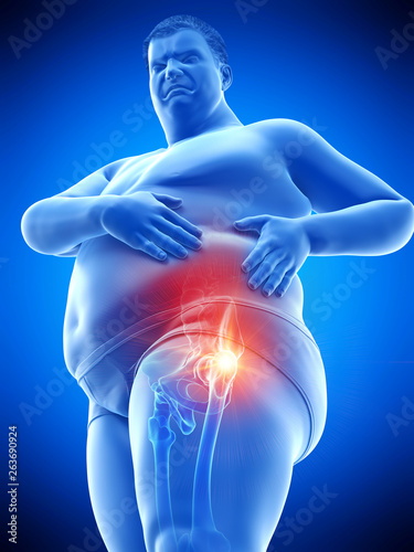 3d rendered medically accurate illustration of an obese mans painful hip joint