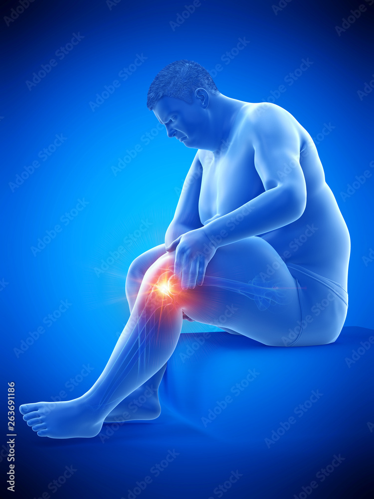 3d rendered medically accurate illustration of an obese mans painful knee 3d rendered medically accurate illustration of an obese mans painful knee