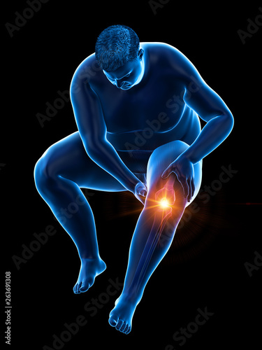 3d rendered medically accurate illustration of an obese mans painful knee