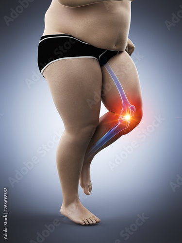 3d rendered medically accurate illustration of an obese runners painful knee