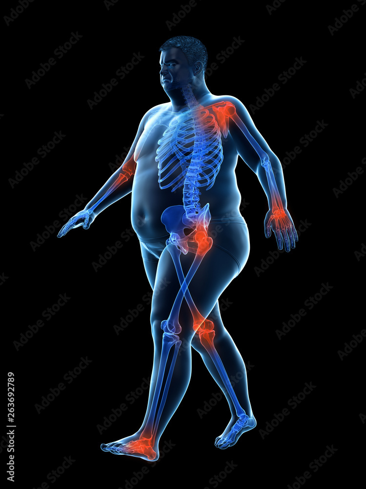 3d rendered medically accurate illustration of an obese runners painful joints 3d rendered medically accurate illustration of an obese runners painful joints