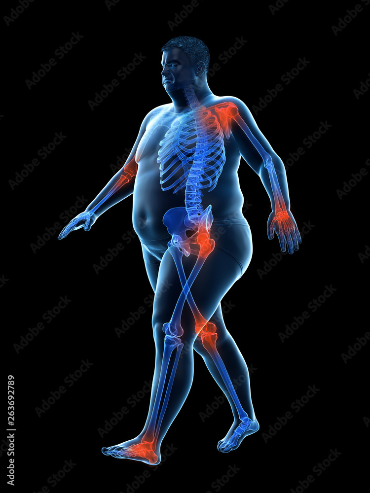 3d rendered medically accurate illustration of an obese runners painful joints