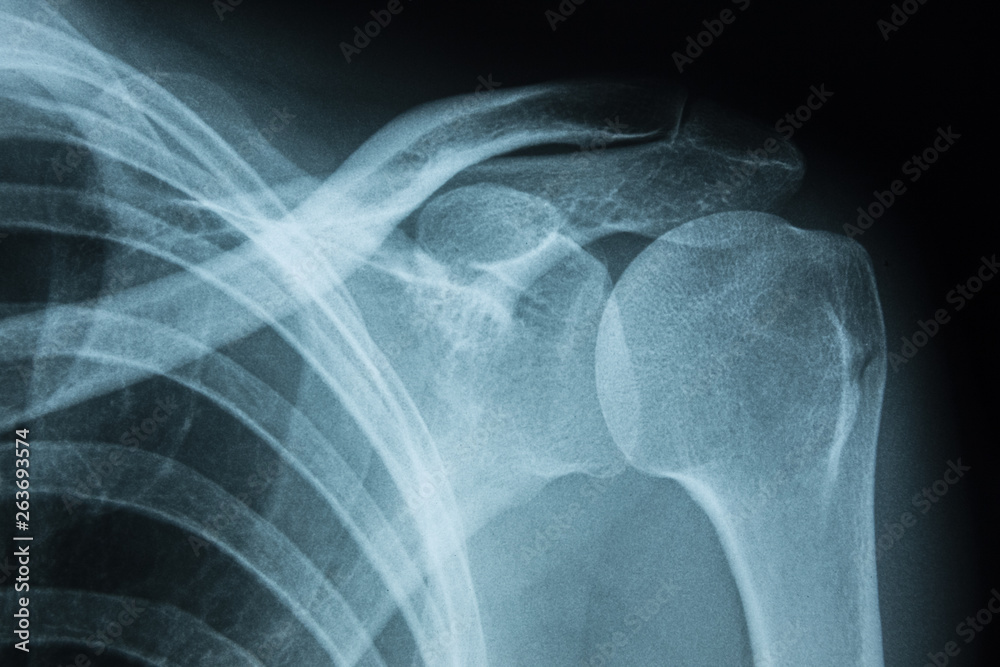 Detail of x-ray of human shoulder bones Detail of x-ray of human shoulder bones