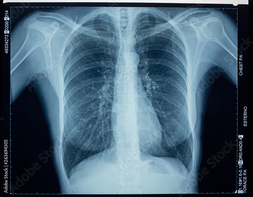 X-ray of the human thorax.