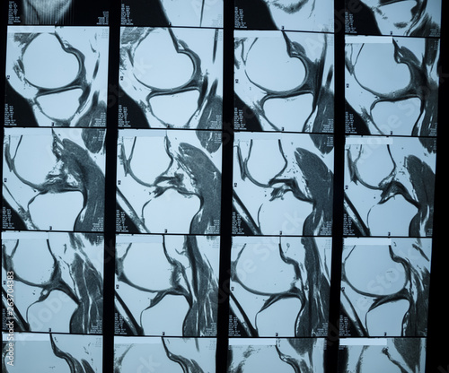 R.M.N. Nuclear magnetic resonance, of human knees, with cross-section and sagittal section. photo