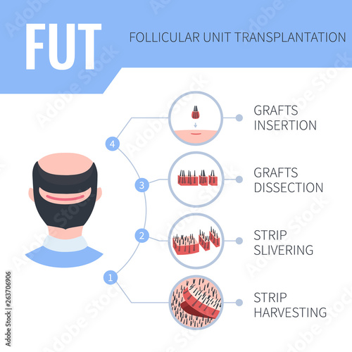 Hair transplantation alopecia treatment by FUT in men. 4 steps infographics. Stages of follicular unit transplantation restoration surgery for male patients. Vector template for clinics.