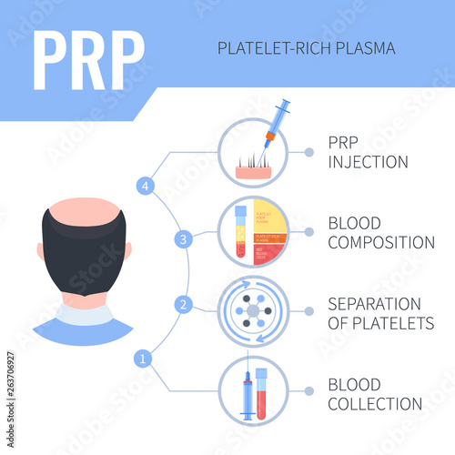 Platelet rich plasma injection procedure. PRP therapy process for men. Male hair loss treatment infographics. Hair regrowth stimulation method. For cosmetology beauty clinic. Vector illustration.