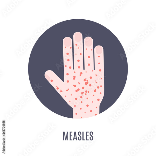 Measles infection awareness medical poster. Hand covered with rash red spots. Virus symptom symbol. Vector illustration.