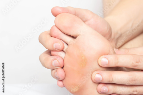 Man shows problem skin on the foot and sole of the foot dry and callous skin with mazols with a stem, close-up, copy space, disease photo