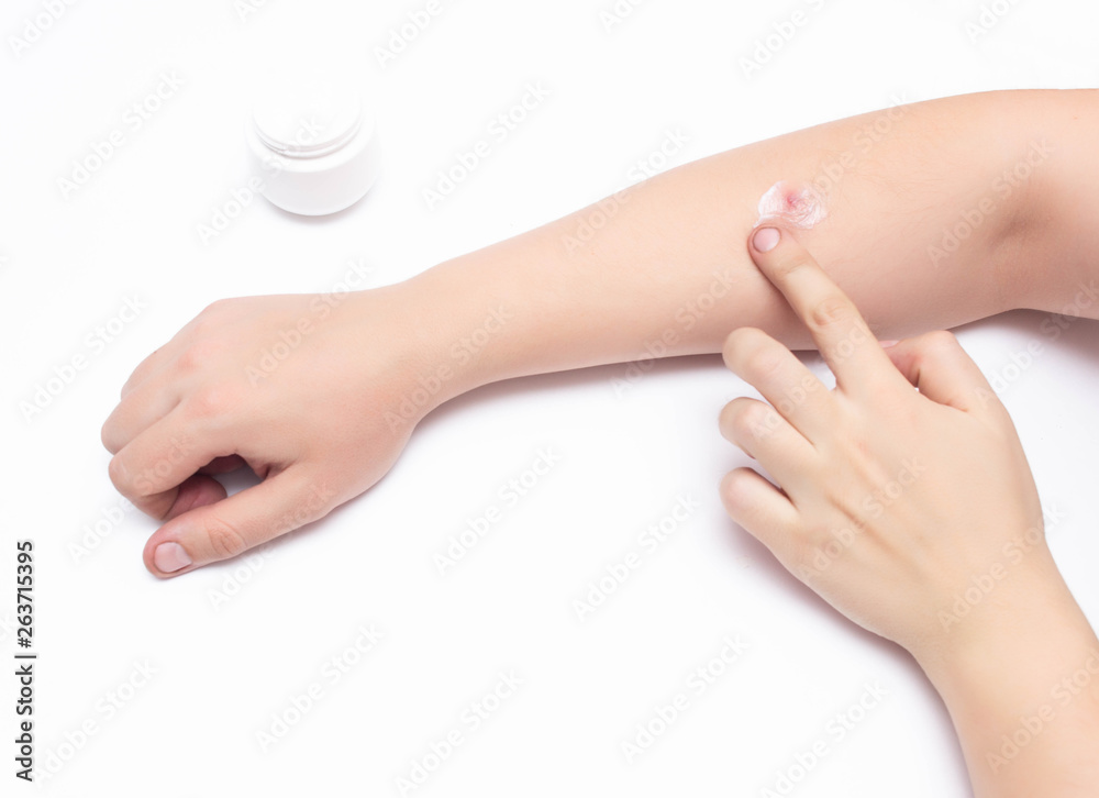 Man smears a medical hormone ointment with a gray red sore pimple on his hand, white background, copy space, dermatology