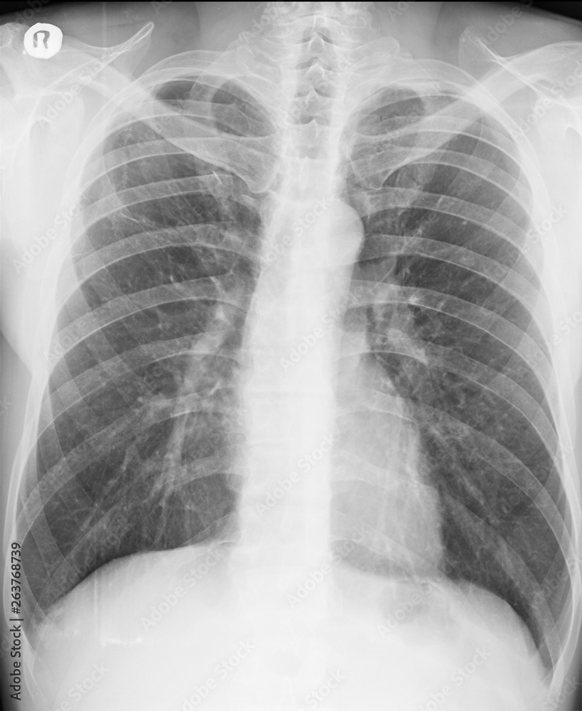 Chest Xray. PA view. Lung fields with persistent pulmonary opacities