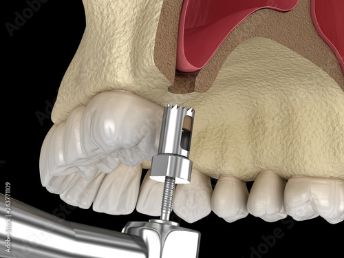 Sinus Lift Surgery - Creating an access to the Sinus. 3D illustration photo