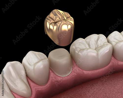 Golden crown premolar tooth assembly process. Medically accurate 3D illustration of human teeth treatment