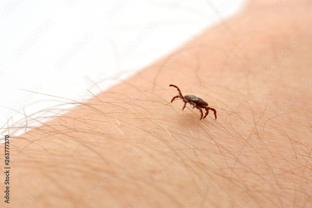 Obraz premium Insect mite on human skin.Parasite ,bloodsucker.