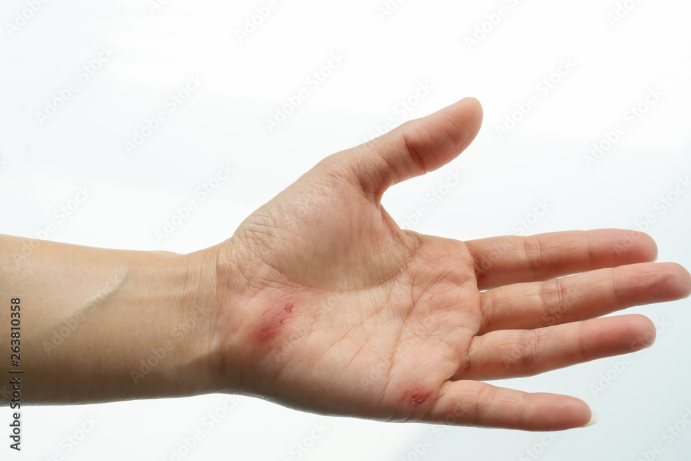 scratch wound on female hand closeup, healthcare and medicine concept scratch wound on female hand closeup, healthcare and medicine concept