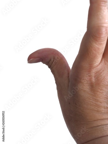 A curved hypermobile thumb photo