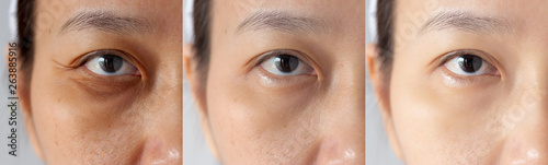 three pictures compared effect Before and After treatment. under eyes with problems of dark circles ,puffiness and wrinkles periorbital before and after treatment to solve skin problem for better skin
