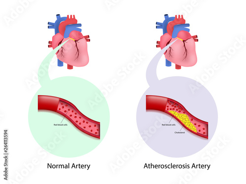 Coronary artery disease in human,  Educational diagram showing blood flow with main parts labeled.