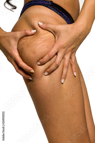 Woman pinching stretch marks and cellulite on her leg on white background