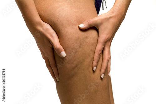 Woman pinching stretch marks and cellulite on her leg on white background