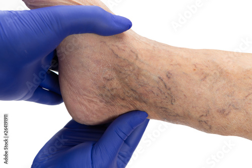 Doctor examining varicose veins on ankle