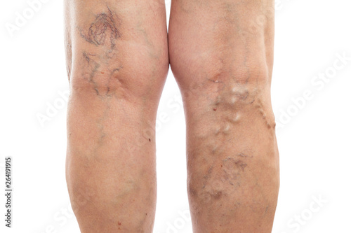 Legs with swollen veins and varicose