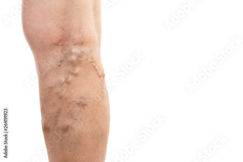 Closeup of swollen veins behind knee
