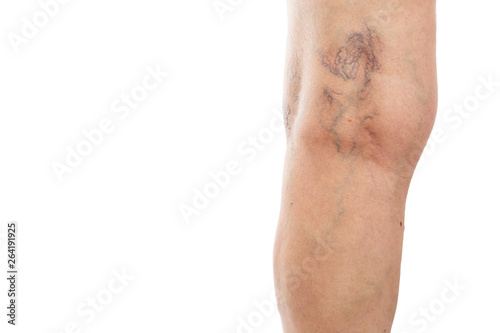 Closeup of varices behind knee