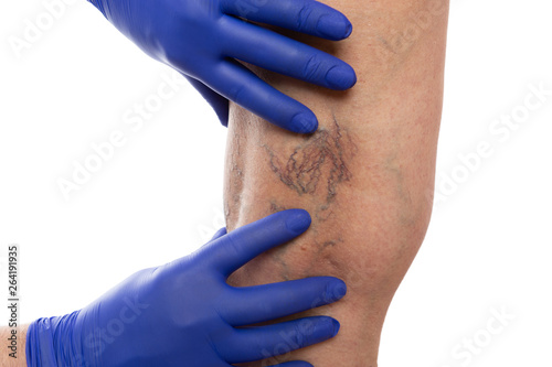 Doctor checking varices on leg of patient photo