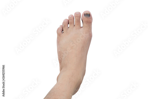 subungual hematoma blood blister beneath the toenail isolated on white background, selective focus (detailed close-up shot)