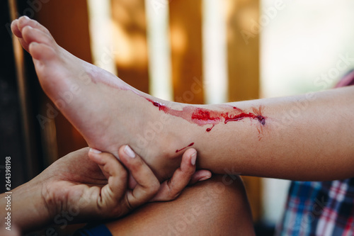 boy with a bleeding injury in leg