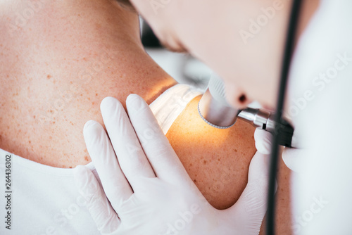 cropped view of dermatologist holding dermatoscope while examining woman with melanoma photo