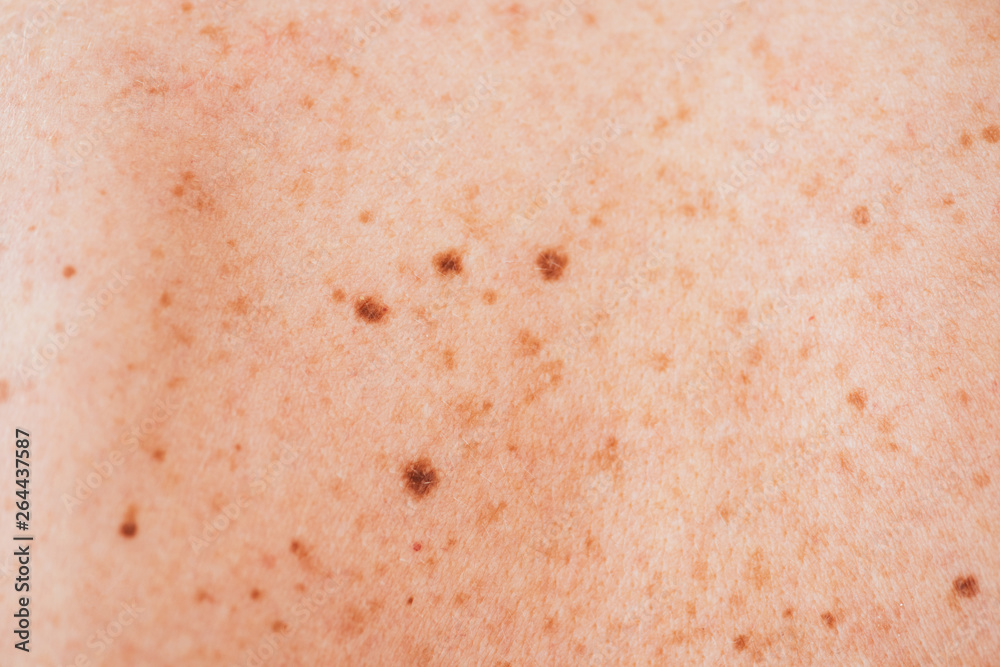 close up of sick woman with melanoma on diseased skin close up of sick woman with melanoma on diseased skin