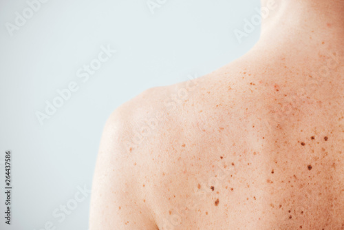 back view of diseased woman with melanoma on skin on white photo