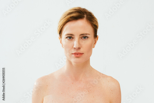 naked sick woman with skin illness looking at camera on white