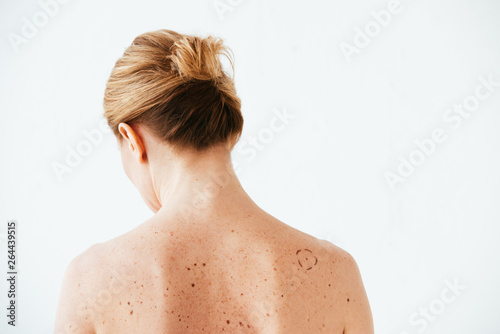 back view of woman with marks on skin isolated on white photo