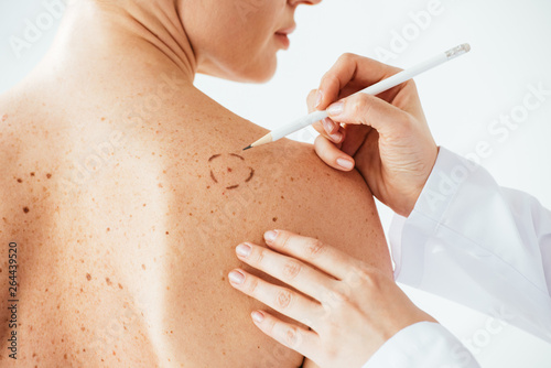 cropped view of dermatologist applying marks on skin of naked woman with melanoma isolated on white photo