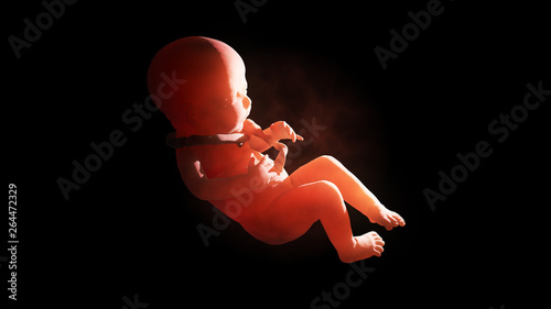Quadro su tela 3d illustration of entanglement of umbilical cord around the fetus