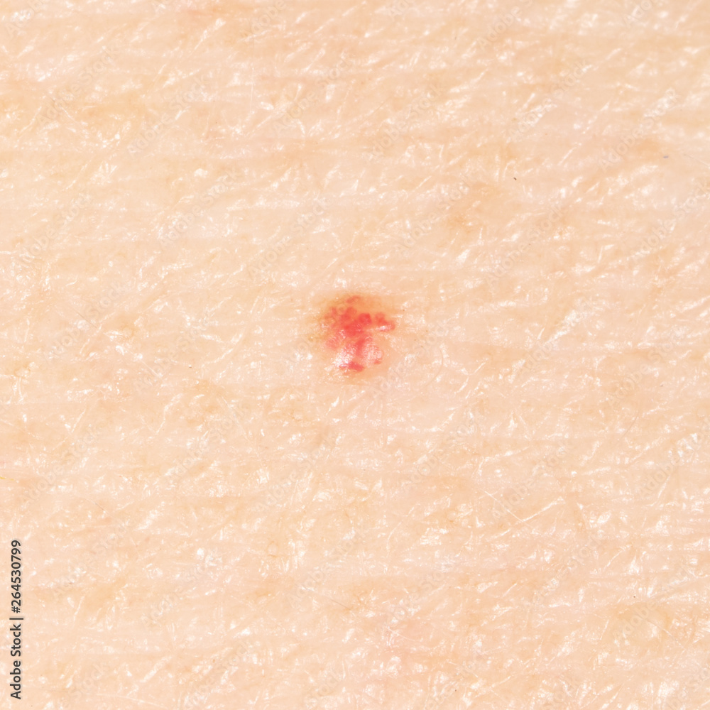 Fototapeta premium Birthmark on human skin.