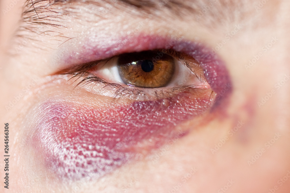 Fototapeta premium Man's face after the fight and assault. Middle-aged Caucasian male Emotional Portrait with a Real Bruise after the fight. Violence.