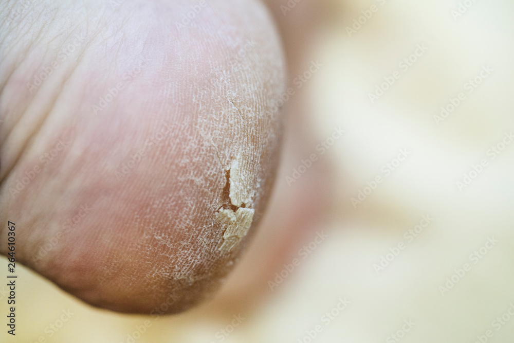 Naklejka premium foot care, cracked skin on heels, close-up