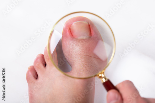 Canvas Print Person Holding Magnifying Glass Over Sore Toe Nail