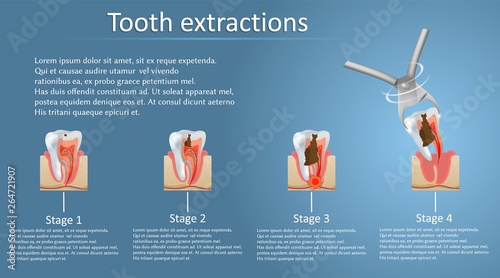 Tooth extraction concept vector poster banner template