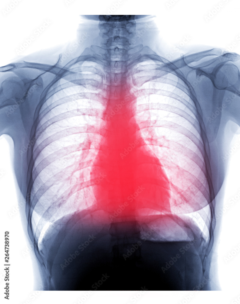 Chest Xray or XRay Image Of Human for detect heart disease and lung