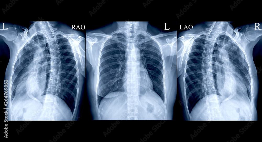 collection Chest X-ray or X-Ray Image Of Human AP and both oblique view ...