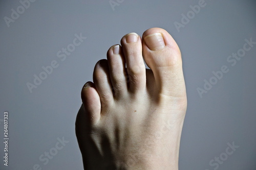 Close-up of foot with early stage of Hallux Valgus foot condition..