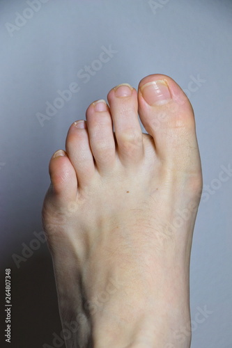 Close-up of foot with early stage of Hallux Valgus foot condition..