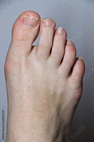 Close-up of foot with early stage of Hallux Valgus foot condition and broken nail..